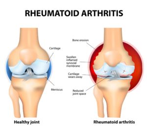 reumatoide artritis